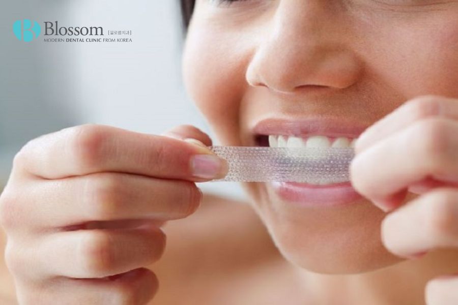 Sử dụng miếng dán trắng răng giúp cải thiện màu răng khá tích cực.