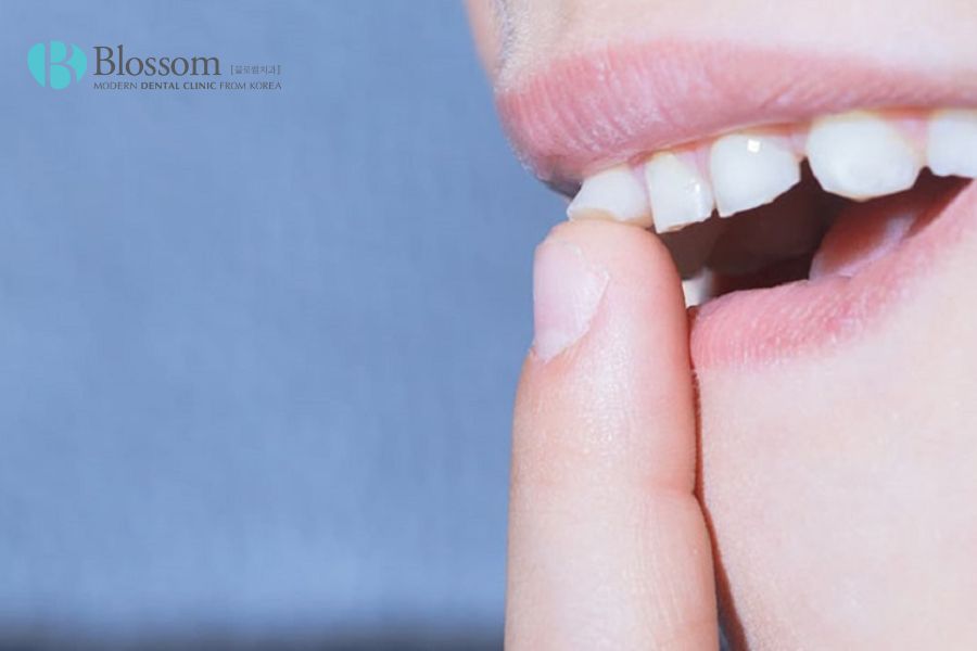 Dùng tay đẩy răng có thể cải thiện răng hô nhẹ nhưng cần kiên trì.