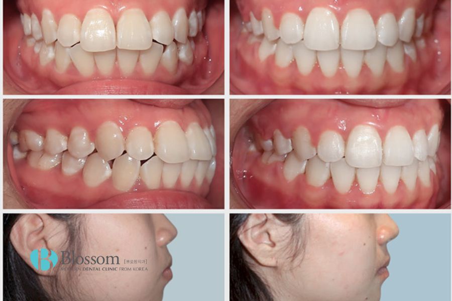 Hô hàm nhẹ là tình trạng răng hàm trên có xu hướng trượt ra phía ngoài so với hàm dưới.