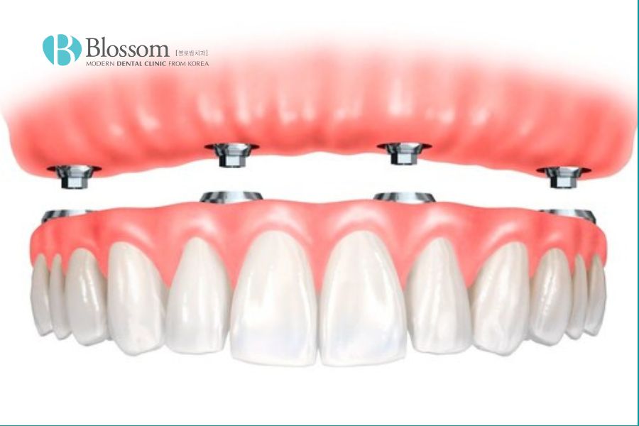 Implant toàn hàm là phương pháp phục hồi hoàn hảo dành cho trường hợp mất răng toàn bộ.
