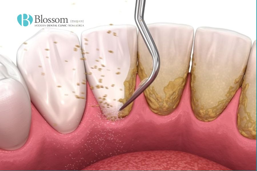 Khám nha sĩ định kỳ 6 tháng một lần để kiểm tra sức khỏe răng miệng và cạo vôi răng.