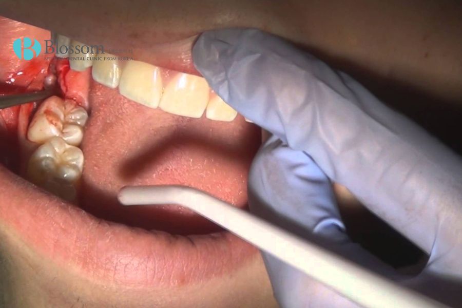 Khi bị đau răng khôn người bệnh nên thăm khám nha sĩ.