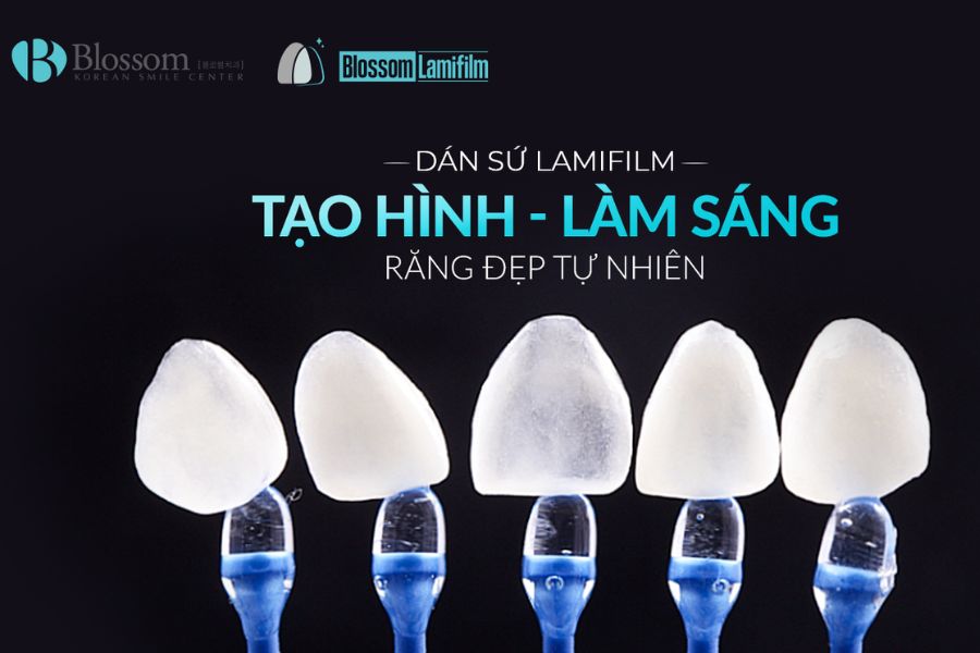 Kỹ thuật dán sứ Lamifilm là công nghệ làm răng sứ hiện đại hàng đầu hiện nay.