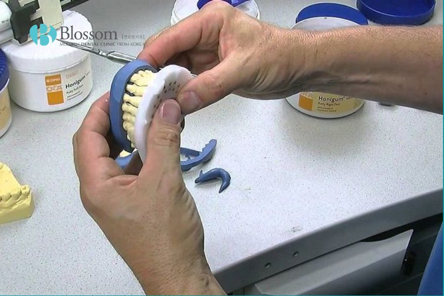 Kỹ thuật lấy dấu răng hai thì là thủ thuật phức tạp như làm cầu răng dài hoặc phục hồi răng implant.