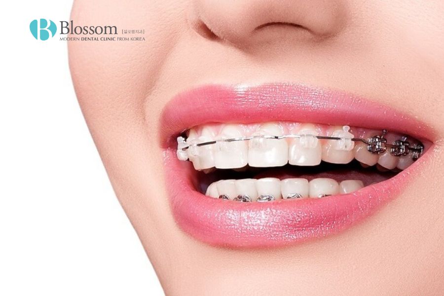 Kỹ thuật niềng răng giúp răng chỉnh nha hiệu quả với những trường hợp răng khấp khểnh