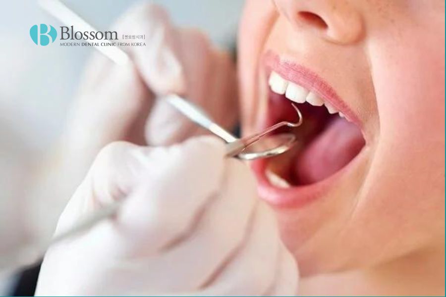 Lấy cao răng định kỳ 6 tháng/lần để loại bỏ mảng bám và cao răng.
