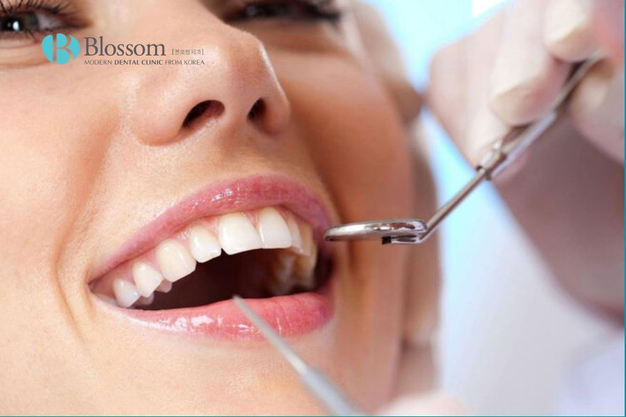 Lấy cao răng định kỳ là biện pháp hiệu quả để loại bỏ mảng bám cao răng.