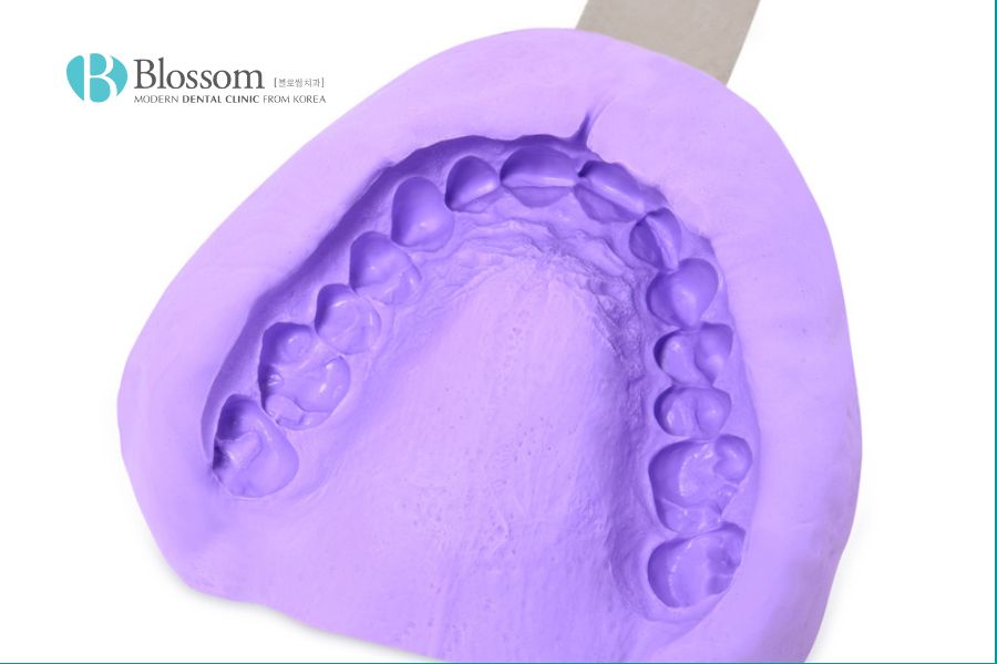 Lấy dấu răng bằng Alginate là một loại vật liệu lấy dấu răng dẻo dai và dễ sử dụng.