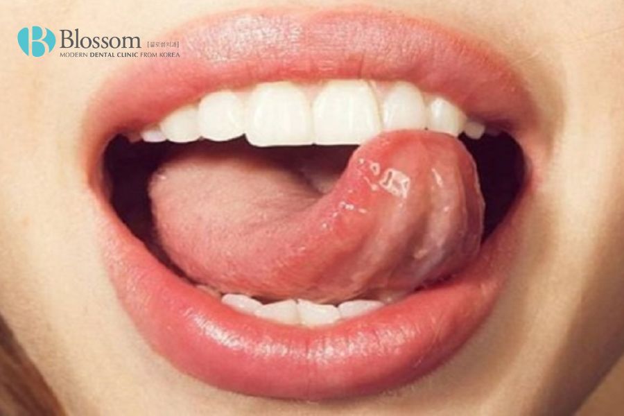 Lưỡi đẩy răng cũng có thể hỗ trợ cải thiện răng hô nhưng không quá lớn.
