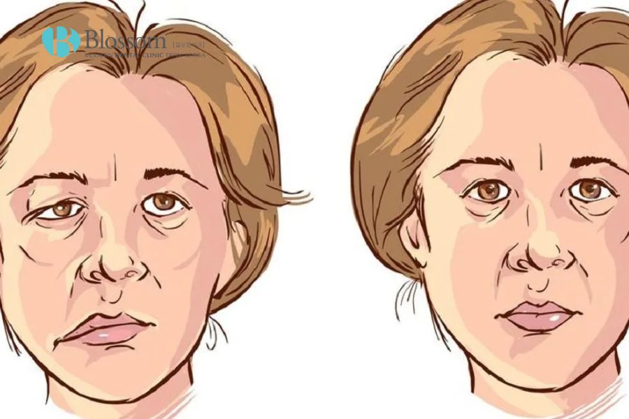 Mặt lệch bên cao bên thấp là hiện tượng dị thường trên khuôn mặt.
