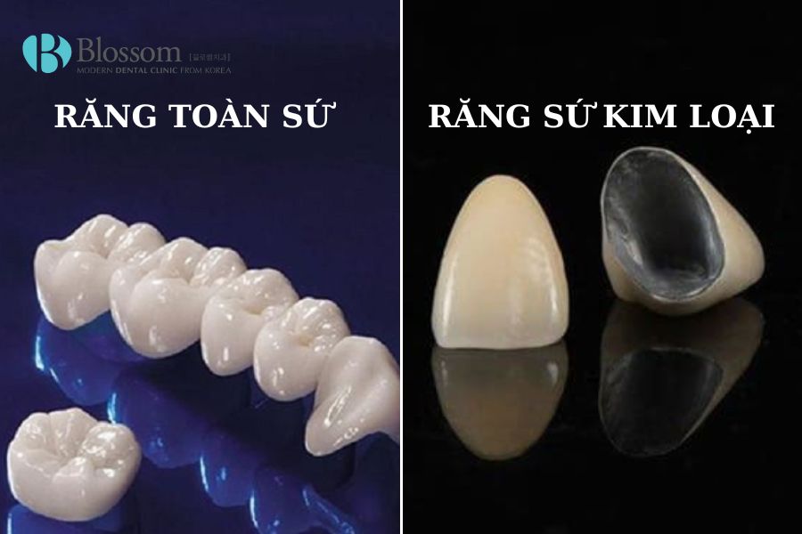 Màu sắc của răng toàn sứ có phần trắng sáng và độ bóng cao so với răng sứ kim loại