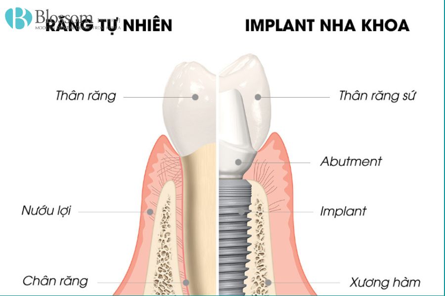 Mỗi răng Implant được cấy ghép độc lập, không cần mài nhỏ hay tác động đến các răng lân cận.