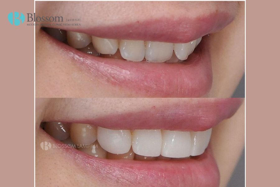 Nha Khoa Blossom sở hữu kỹ thuật dán sứ Lamifilm độc quyền, cho màu sắc răng tự nhiên như răng thật