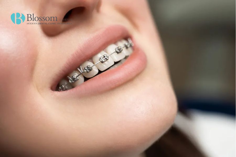 Niềng răng là lựa chọn tốt để cải thiện có hiệu quả tình trạng mặt lệch.
