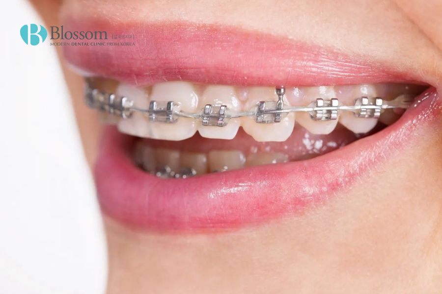Niềng răng là phương pháp chỉnh răng hô được nhiều người lựa chọn áp dụng.
