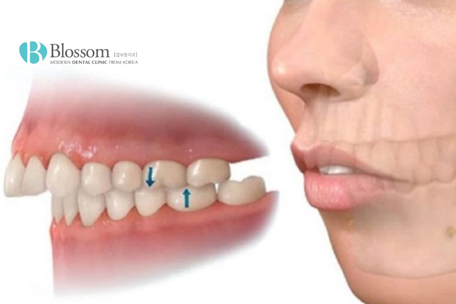 Niềng răng mang lại hiệu quả tích cực với tình trạng hô răng.