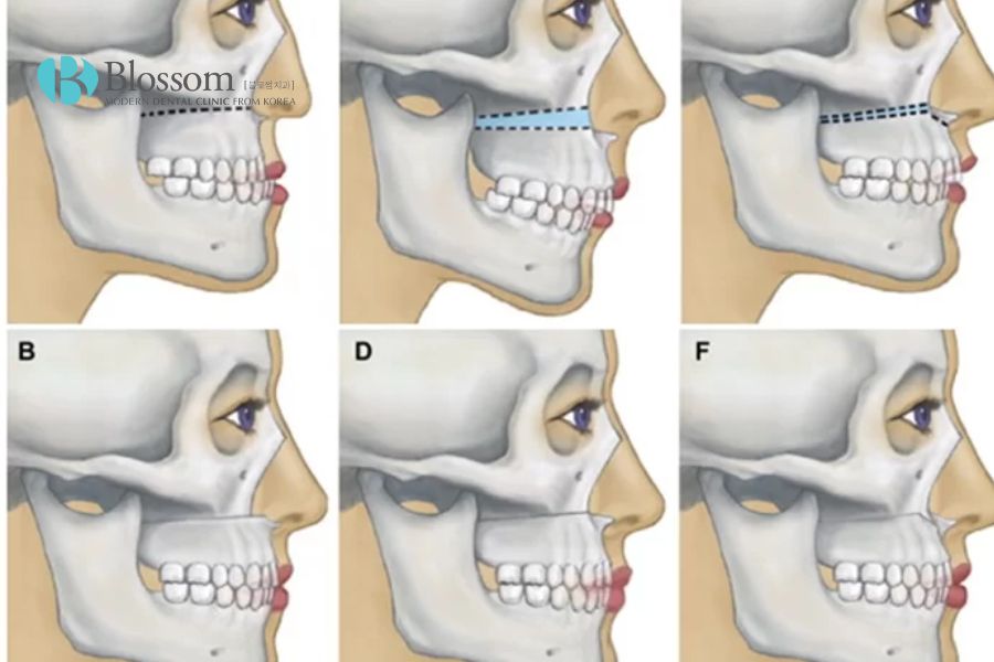 Phẫu thuật hàm chỉ định cho các trường hợp răng hô phức tạp.