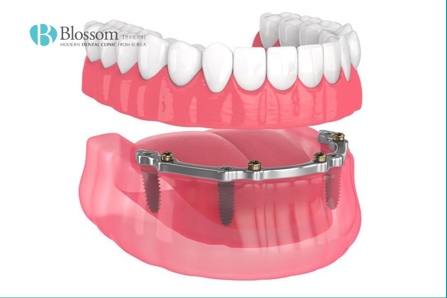 Phục hình răng cố định mang lại tính thẩm mỹ cao, thiết kế gần giống với răng thật.