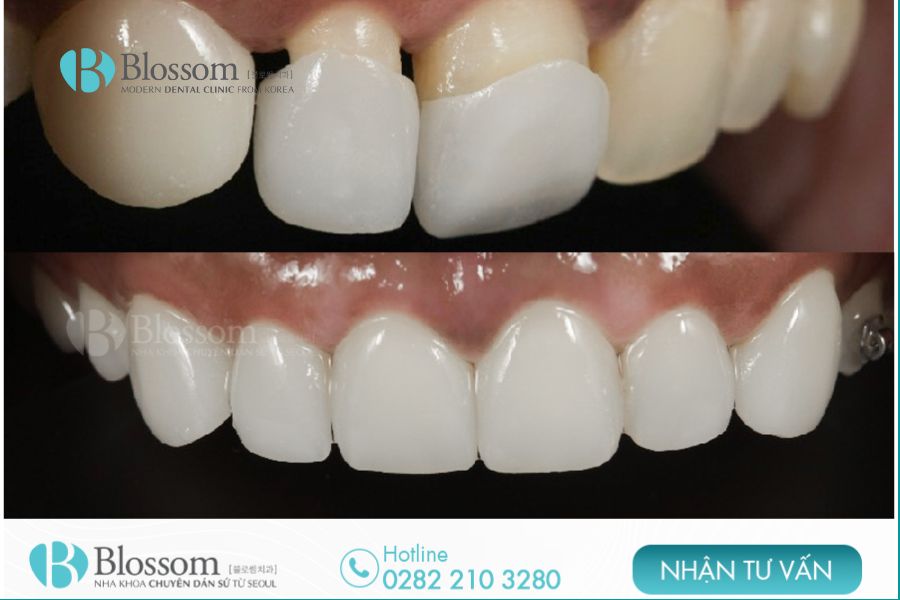 Phục hình răng là biện pháp hoàn hảo giúp giải quyết các vấn đề răng miệng hiệu quả.