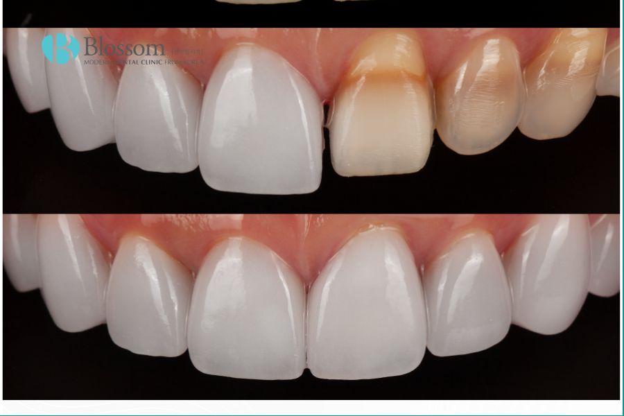 Phục hình răng là kỹ thuật nha khoa tiên tiến giúp cải thiện các khuyết điểm về răng.