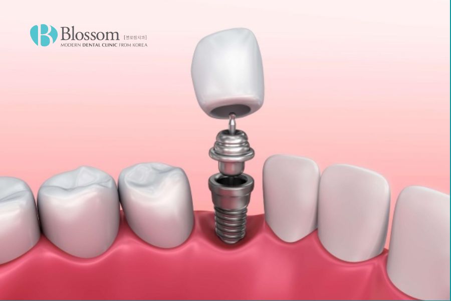 Phục hình răng sứ trên Implant là giải pháp giúp phục hồi răng đã mất một cách tối ưu.