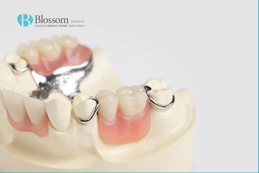 Phục hình răng tháo lắp có ưu điểm chi phí thấp, thời gian thực hiện nhanh chóng.