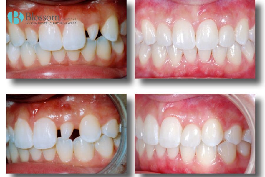 Phương pháp bọc răng sứ mang đến khuôn hàm răng khít, đều đặn.
