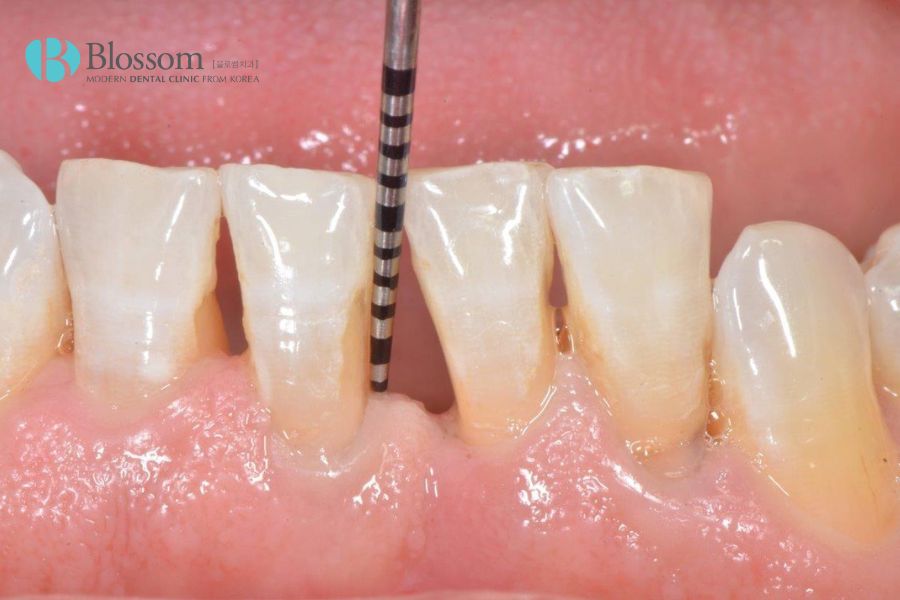 Phương pháp điều trị răng thưa tại nhà với dây thun được nhiều người áp dụng.