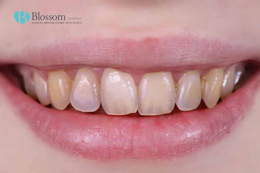 Răng bị đổi màu không gây nguy hiểm tới sức khỏe bệnh lý nhưng ảnh hưởng rất lớn đến thẩm mỹ nụ cười