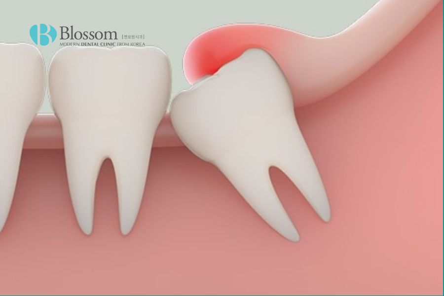 Răng khôn mọc lệch là nguyên nhân phổ biến gây nên tình trạng sưng nướu răng trong cùng.