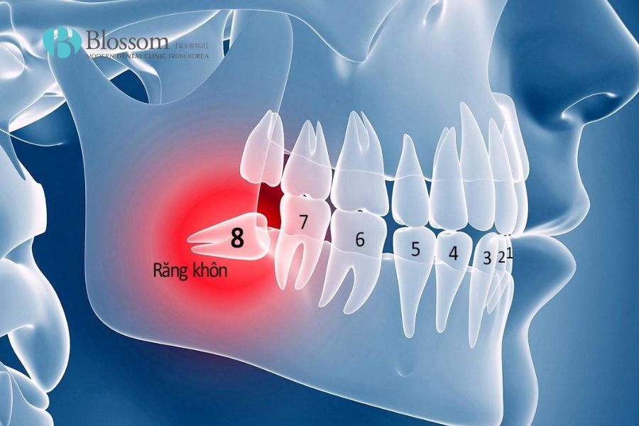 Răng khôn mọc ngầm khiến người bệnh phải chịu cơn đau ê buốt kéo dài.