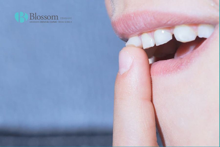 Răng lung lay là dấu hiệu cho thấy bệnh nha chu đã tiến triển nặng.