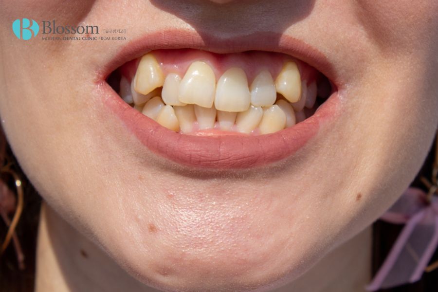 Răng mọc không đều gây khó khăn trong quá trình vệ sinh răng