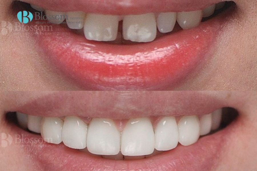 Răng ố vàng là tình trạng nha khoa rất thường gặp.