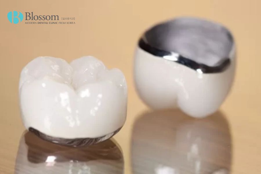 Răng sứ Chrom-Cobalt đảm bảo tính tương thích sinh học cao