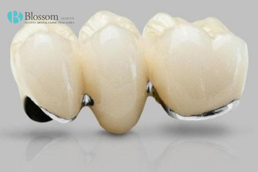 Răng sứ Chrom-Cobalt phù hợp với phương pháp trồng răng Implant toàn hàm