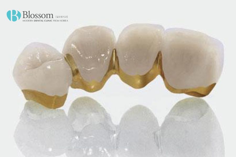 Răng sứ kim loại quý có độ thẩm mỹ cao, không bị đen viền nướu