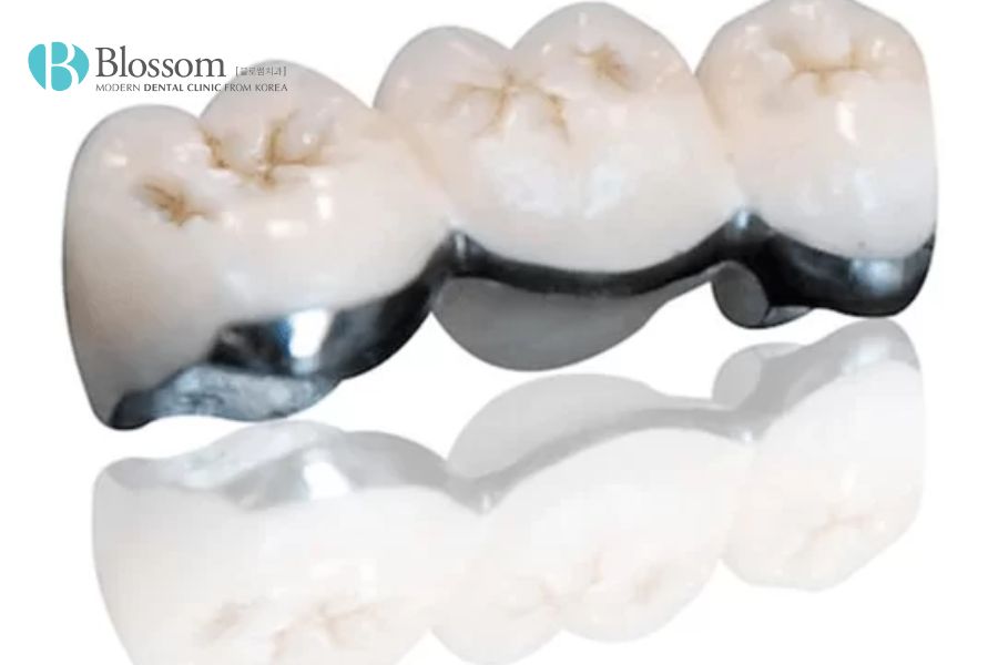 Răng sứ kim loại thường có khả năng chịu lực khá tốt