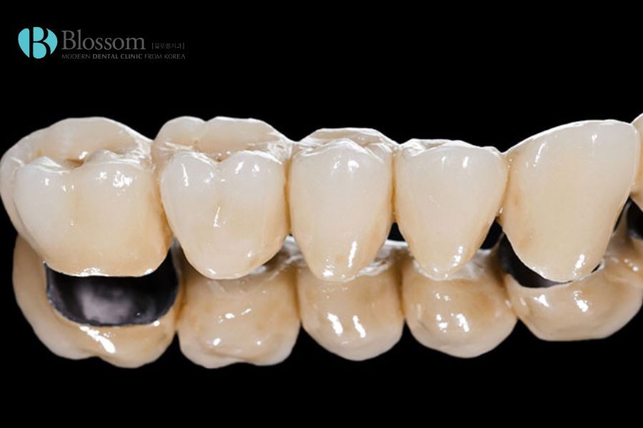 Răng sứ kim loại với lớp sứ Ceramco cho màu sắc hài hòa và tự nhiên