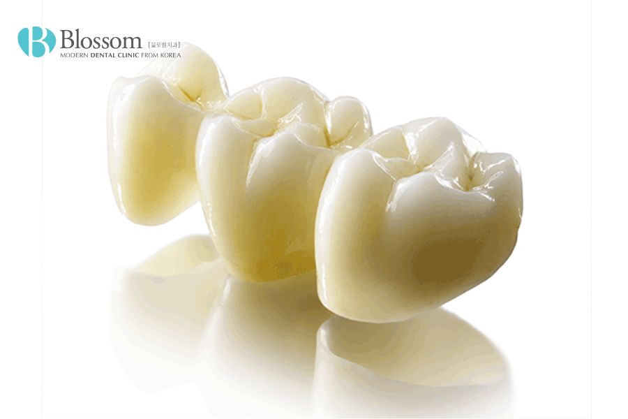 Răng sứ Lava Plus 3M ESPE có độ cứng cao gấp 8 - 9 lần so với răng thật
