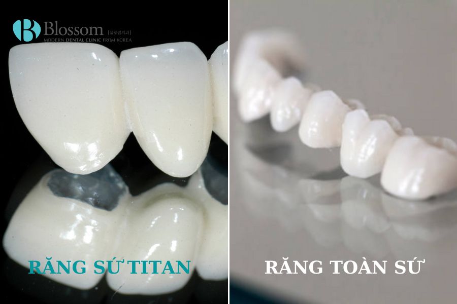 Răng sứ Titan có chi phí thực hiện thấp hơn so với răng toàn sứ
