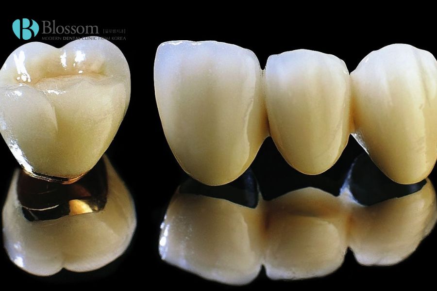 Răng sứ Titan phù hợp với đối tượng bị dị ứng với kim loại