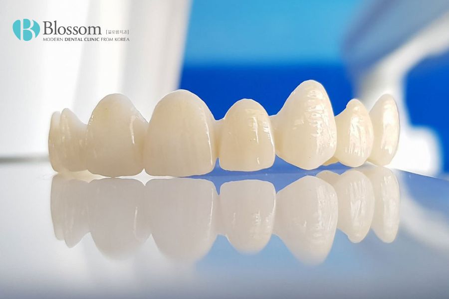 Răng toàn sứ được chế tác bằng công nghệ CAD/CAM 3D hiện đại