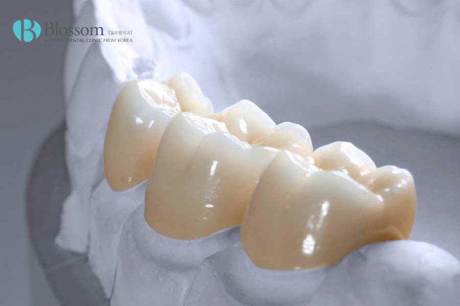 Răng toàn sứ Multilayer Ddbio an toàn, không gây kích ứng khi sử dụng