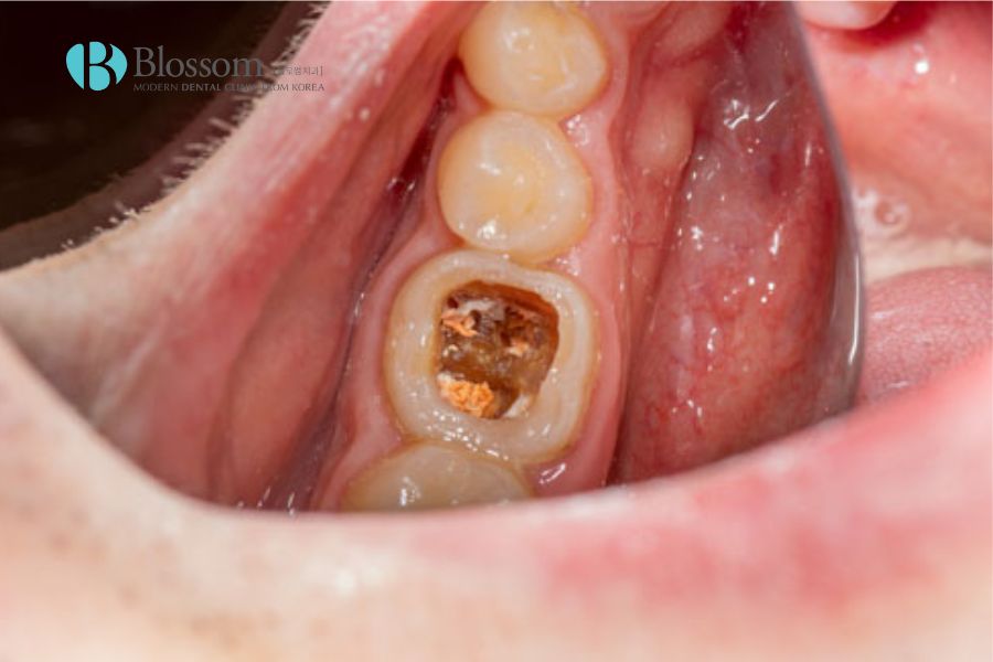 Sâu răng ăn sâu đến tủy răng là giai đoạn nghiêm trọng cần được điều trị nha khoa chuyên sâu.
