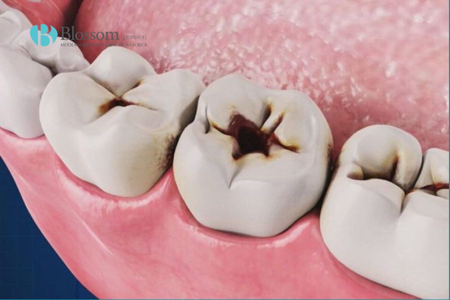 Sâu răng hàm là nguyên nhân gây sưng nướu răng, thường gặp ở cả trẻ em và người lớn.