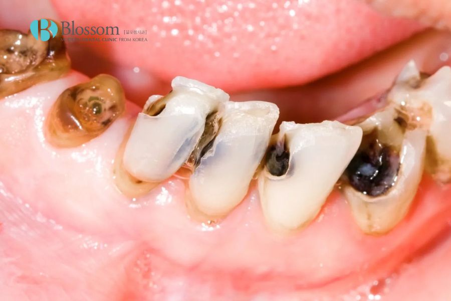 Sâu răng là một trong những nguyên nhân nhức răng phổ biến, thường gặp.