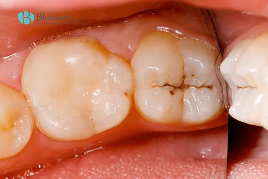 Sâu răng ở mức độ nhẹ có đặc trưng là các đốm đen nhỏ xuất hiện ở kẽ và bề mặt răng.