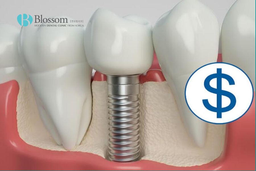 So với các phương pháp phục hình răng khác cấy ghép Implant có chi phí cao hơn.