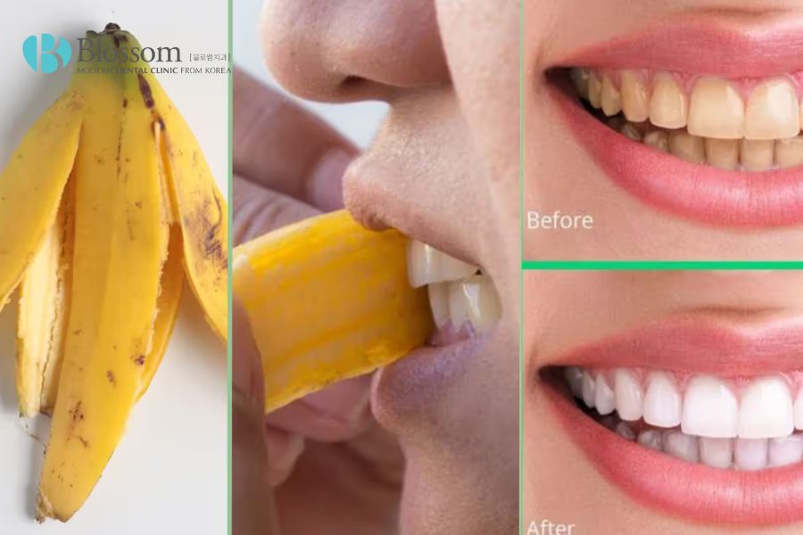 Thành phần của vỏ chuối có nhiều khoáng chất tốt cho răng.